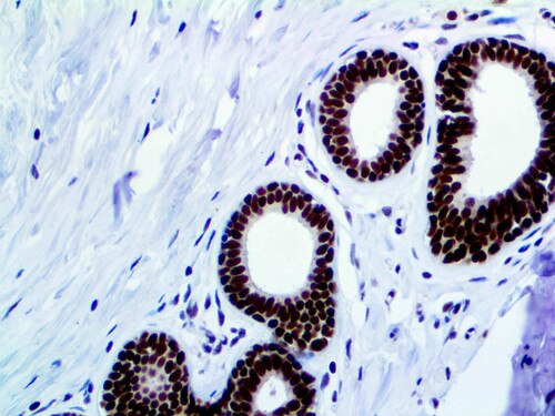 IHC of FOXP1 on an FFPE Breast Tissue